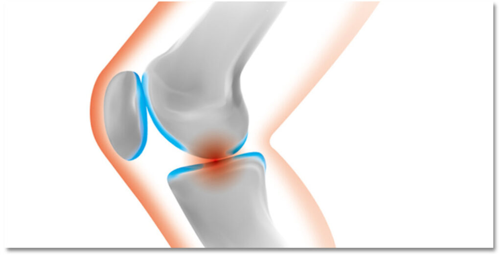 膝関節の炎症