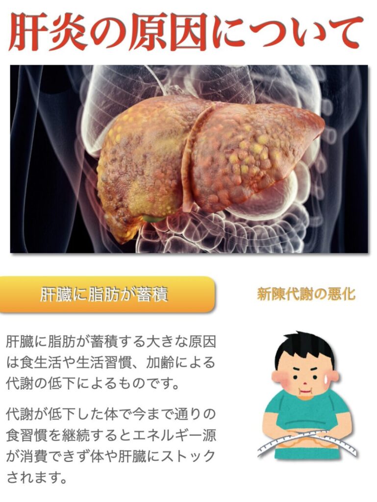 肝炎の原因について
・肝臓に脂肪が蓄積する
肝臓に脂肪が蓄積する大きな原因は食生活や生活習慣の乱れ加齢による代謝の低下などです。
肝臓で炎症を起こす脂肪肝には２種類存在します。